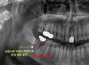 부평사랑니 방치