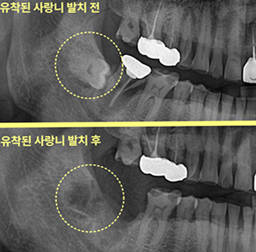 부평사랑니 방치