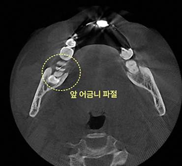 부평사랑니 방치
