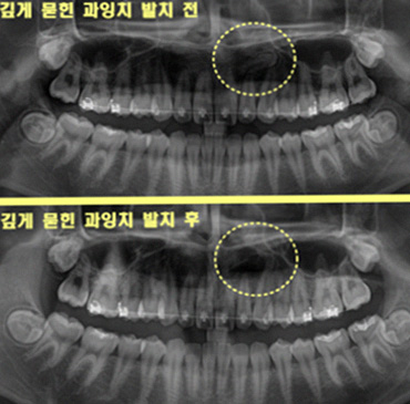 인천구월동치과 우리 아이 과잉치발치, 구강악안면외과 전문의가 필요한 결정적 이유 4 그림14