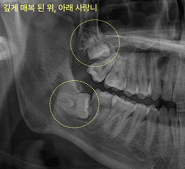위아래 동시 발치, 마취 한 번으로 끝내도 괜찮을까? 구강악안면외과 전문의의 분석 3 구강악안면외과 전문의