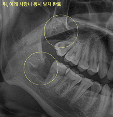 위아래 동시 발치, 마취 한 번으로 끝내도 괜찮을까? 구강악안면외과 전문의의 분석 4 구강악안면외과 전문의