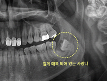 간석동치과 사랑니 발치 후 회복이 느려 고민인가요? 인천구월동치과 전문의가 전하는 정밀 사후 관리법 4 그림5