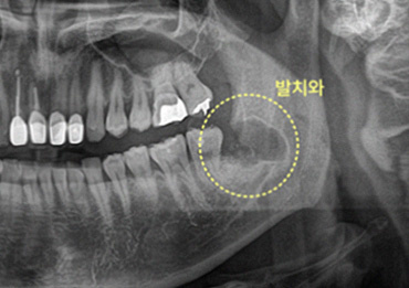 간석동치과 사랑니 발치 후 회복이 느려 고민인가요? 인천구월동치과 전문의가 전하는 정밀 사후 관리법 5 그림6
