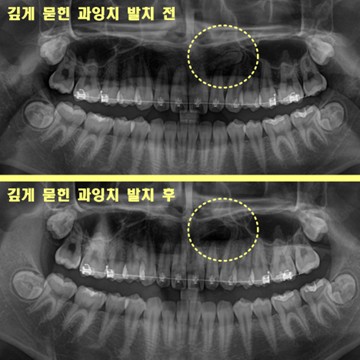 깊게 묻힌 과잉치 발치 전 후 촬영일 250814 250828