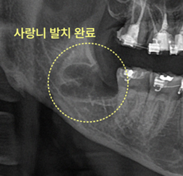 발치 전후 비교 엑스레이