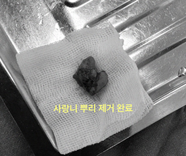 사랑니뿌리제거