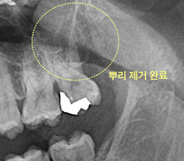 성공적으로 제거된 사랑니 뿌리 엑스레이