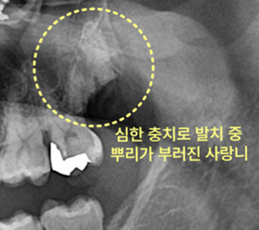 타원 발치 후 부리가 부러진 채로 오셨던 케이스