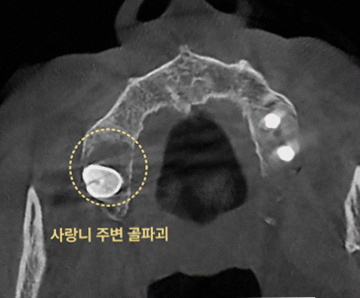 인천구월동치과 어금니 임플란트 전 사랑니 확인 필수? 잇몸뼈 소실 막는 선제적 발치 전략 4 40