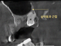 구월동 사랑니, 아프기 전에도 봐야 하는 순간 참고 사진 3