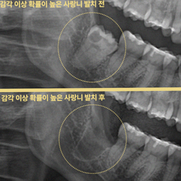 구월동 사랑니, 아프기 전에도 봐야 하는 순간 참고 사진 5