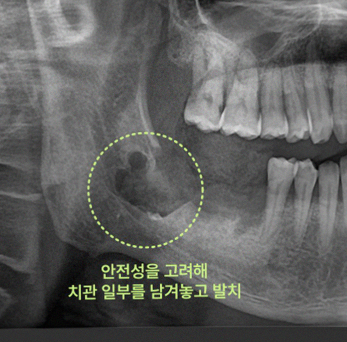 배곧치과 신경관 근접 사랑니, 무리한 발치보다 '안전'을 택해야 하는 의학적 이유 3 그림19