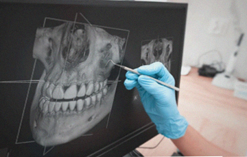 사랑니 발치 전 3D CT는 과잉진료인가요? 2 그림33