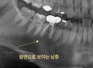 사랑니 발치 전 3D CT는 과잉진료인가요? 3 그림34