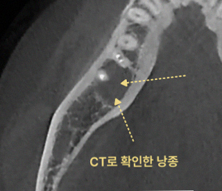 사랑니 발치 전 3D CT는 과잉진료인가요? 5 그림36