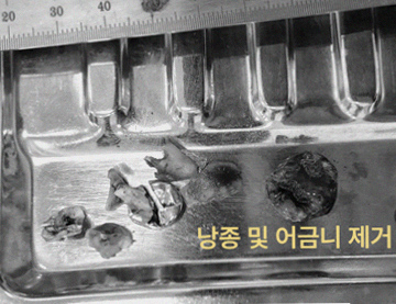 사랑니 발치 전 3D CT는 과잉진료인가요? 6 그림37