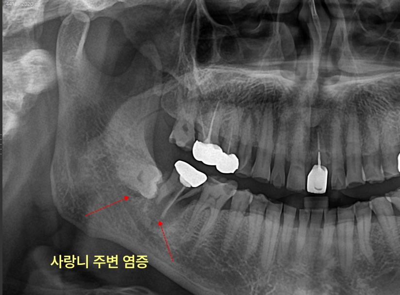 사랑니 주변 염증이 보이는 엑스레이 사진.