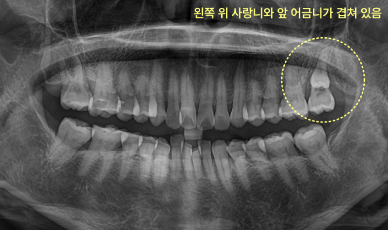 왼쪽 위 사랑니와 앞 어금니가 겹쳐 있는 엑스레이 사진