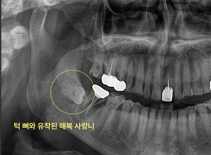 턱뼈와 유착된 매복 사랑니 엑스레이 사진.