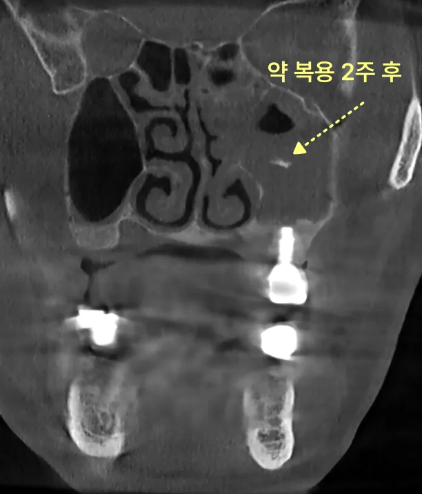 약 복용 2주 후 상악동 내부 CT 사진