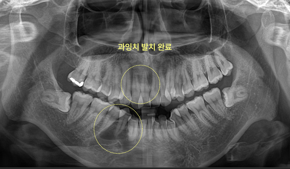 과잉치, 왜 구강악안면외과 전문의에게 맡겨야 할까요? 8 과잉치 발치 완료 후 엑스레이 사진