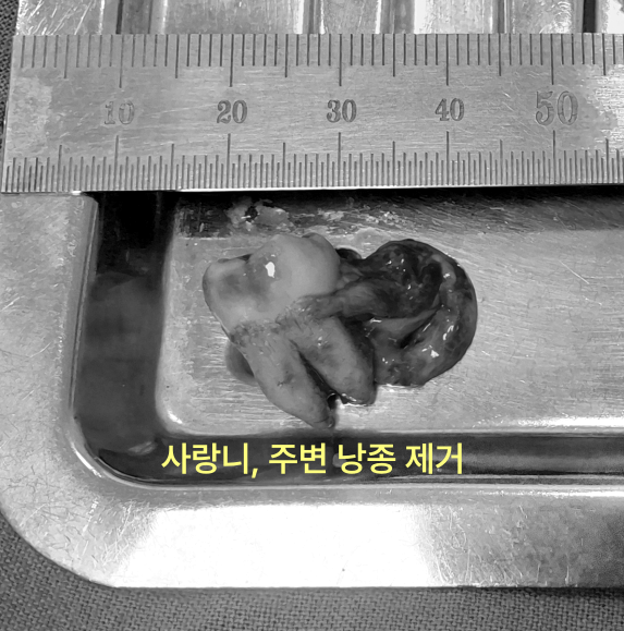 사랑니와 주변 낭종 제거 후 모습