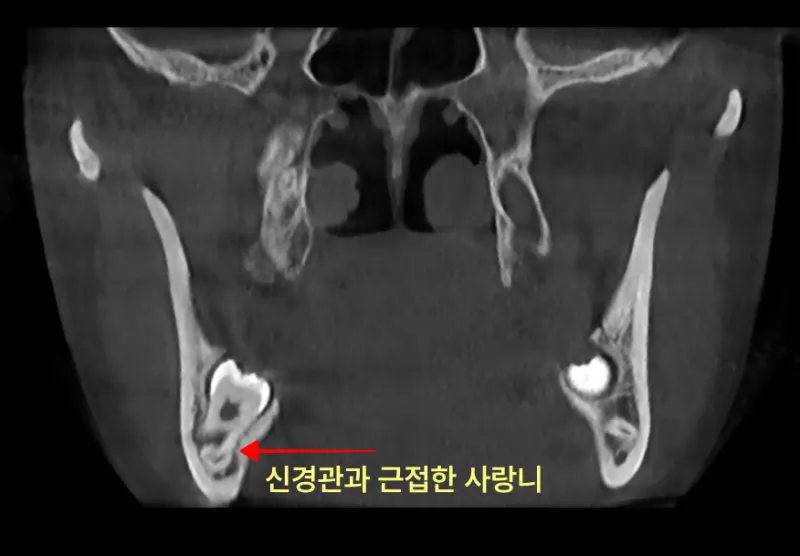 인천사랑니치과 발치 중 턱뼈 골절 가능성은? 6 신경관과 근접한 사랑니 CT