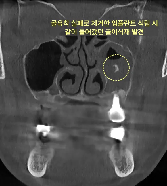 임플란트 식립 시 들어갔던 골이식재가 발견된 CT 사진.