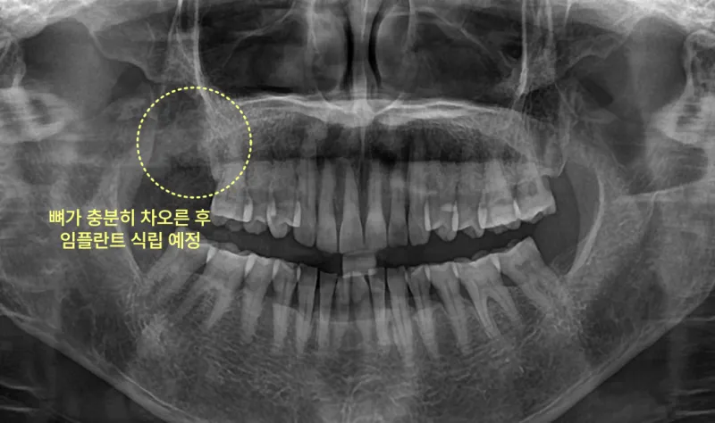 뼈가 충분히 차오른 후 임플란트 식립 예정 부위를 보여주는 엑스레이 사진