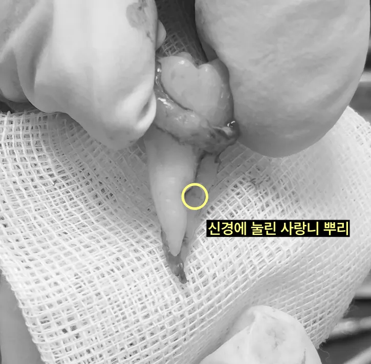 매복 사랑니에 CT 촬영이 필요한 경우는 언제인가요? 7 신경에 눌린 사랑니 뿌리 발치 사진