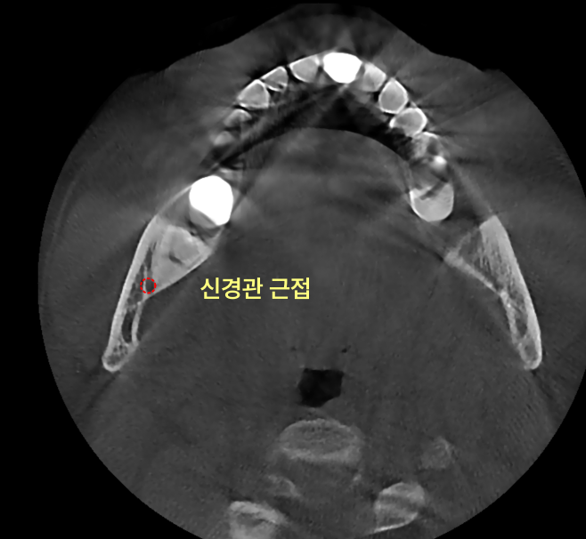 신경관과 근접한 사랑니 CT 사진.
