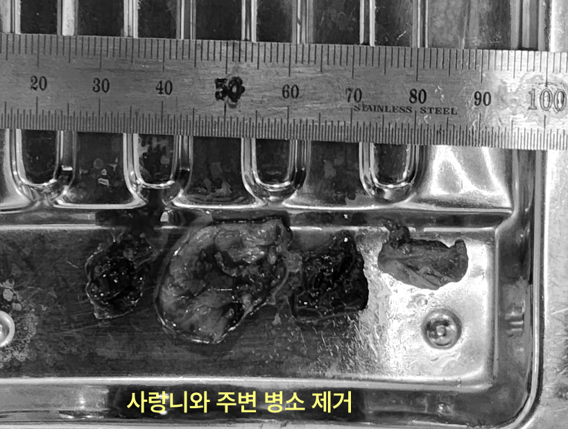 사랑니를 방치하면 앞 어금니까지 뽑아야 하나요? 6 제거된 사랑니와 주변 병소 조직들