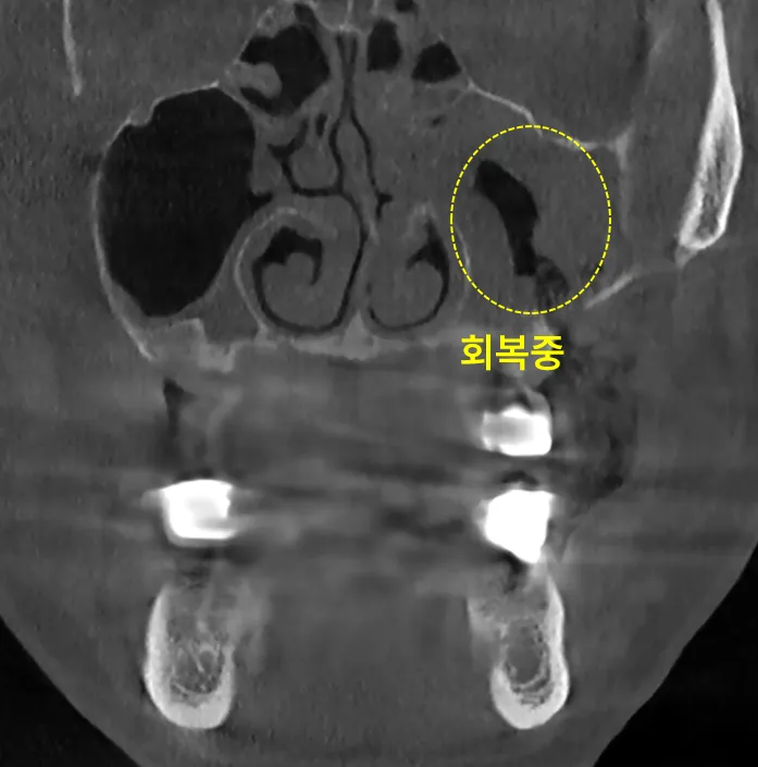 인천임플란트 실패하면 이렇게 돼요-사진 有