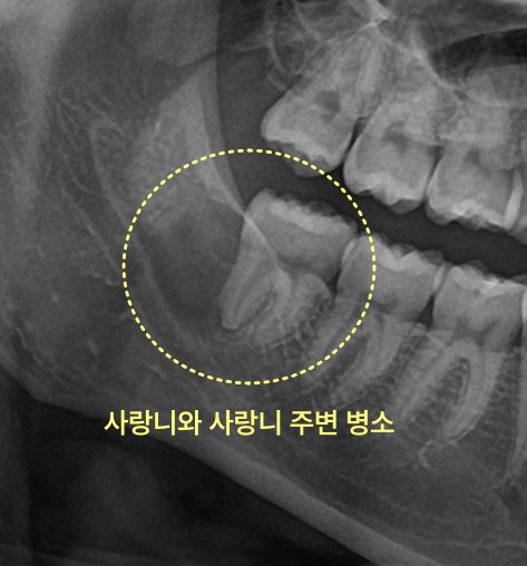 사랑니와 주변 병소가 노란 점선 원으로 표시된 엑스레이 사진.