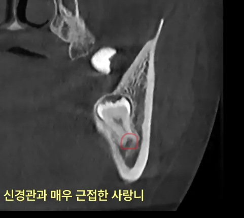 신경과 가까운 사랑니를 방치하면 어떻게 되나요? 10 신경관과 매우 근접한 사랑니 CT 확대 사진