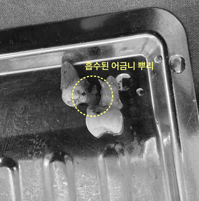 발치된 어금니와 사랑니가 쟁반 위에 놓여 있고, 흡수된 어금니 뿌리가 노란색 원으로 표시되어 있다.