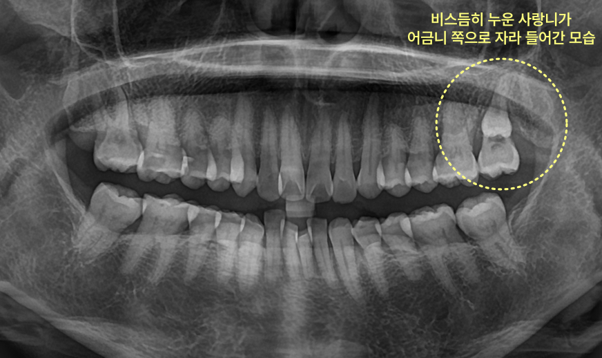 전체 치아 엑스레이 사진에서 비스듬히 누운 사랑니가 어금니 쪽으로 자라 들어간 모습이 노란색 원으로 표시되어 있다.