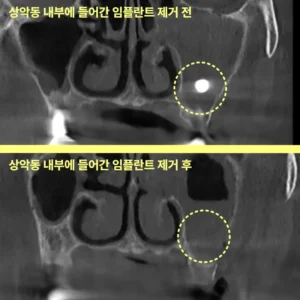 인하대역치과 임플란트 후 경과 관찰이 이렇게 중요해요