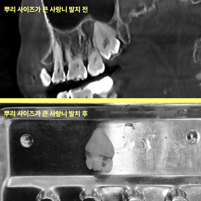 사랑니 뿌리가 굵어지면 발치가 더 어려워지나요? 10 뿌리 사이즈가 큰 사랑니 발치 전후 사진 비교