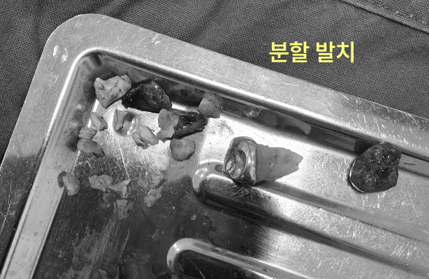 사랑니 발치, 미루면 더 힘들어지는 이유