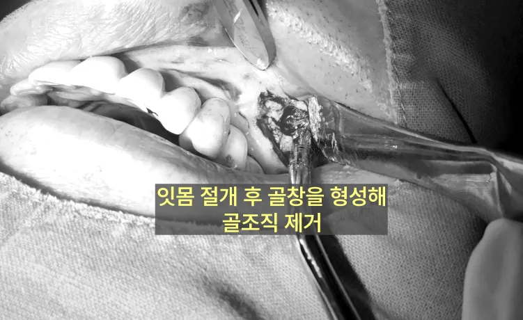 인천임플란트 실패하면 이렇게 돼요-사진 有