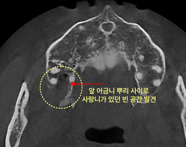 CT 사진에 앞 어금니 뿌리 사이의 사랑니가 있던 빈 공간이 노랗게 표시되어 있다.