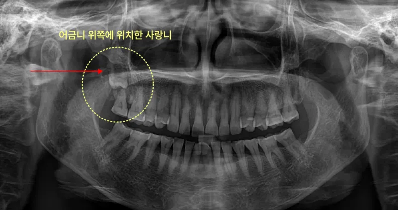 어금니 위쪽에 위치한 사랑니를 보여주는 엑스레이 사진