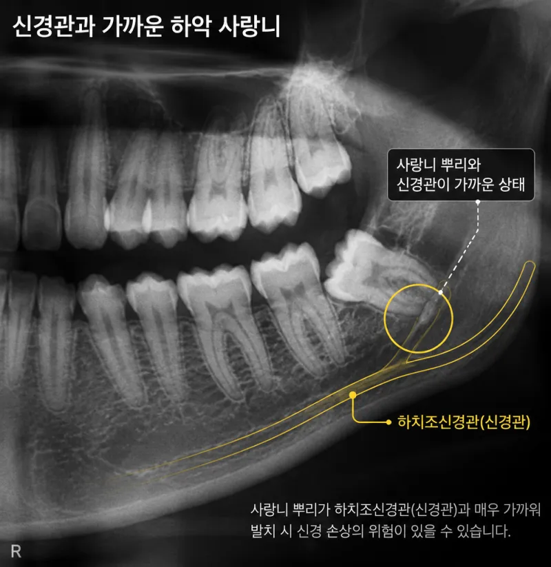 신경과 가까운 사랑니를 방치하면 어떻게 되나요? 6 사랑니 뿌리와 신경관이 가까운 하악 사랑니 엑스레이 사진