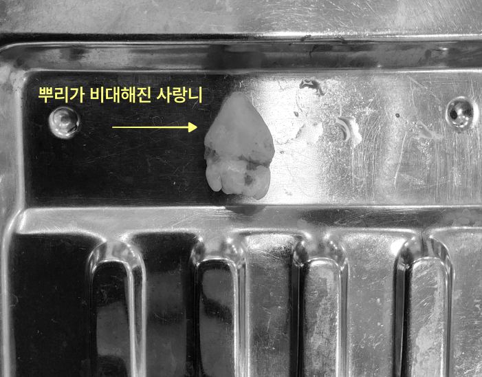 사랑니 뿌리가 굵어지면 발치가 더 어려워지나요? 6 의료용 쟁반 위에 뿌리가 비대해진 사랑니가 놓여 있다.