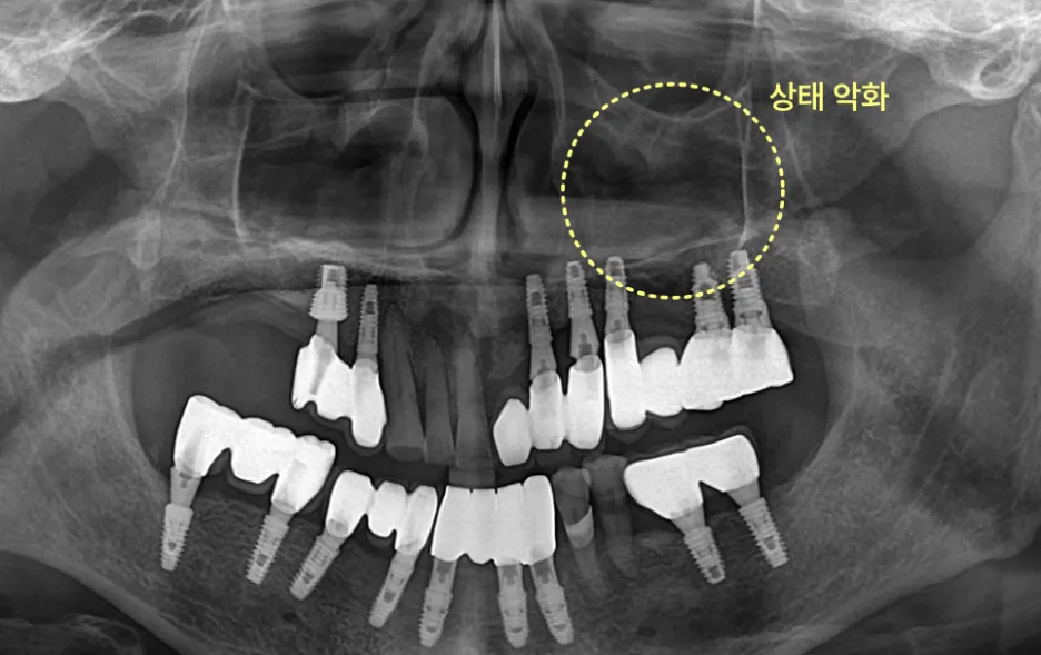 상태 악화가 표시된 치아 X-ray 사진