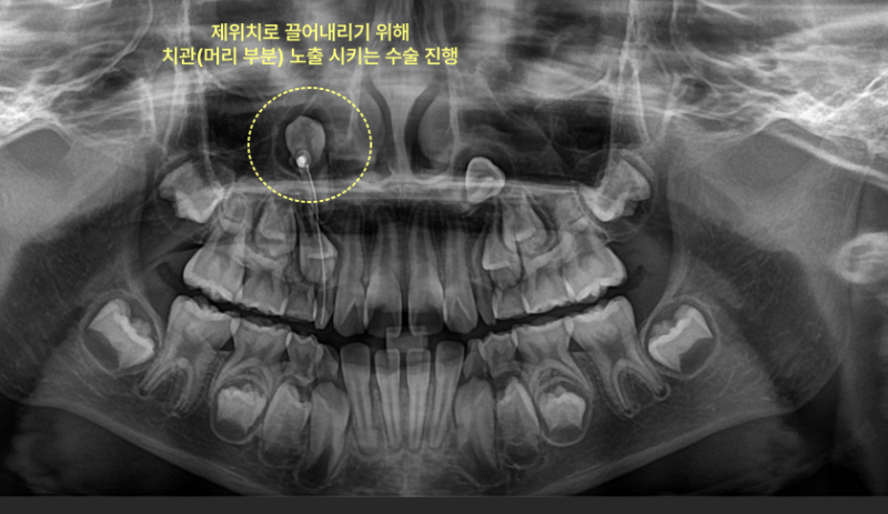 아이 송곳니가 안 나옵니다, 기다려도 될까요? 5 송곳니 노출 수술 진행 X-ray