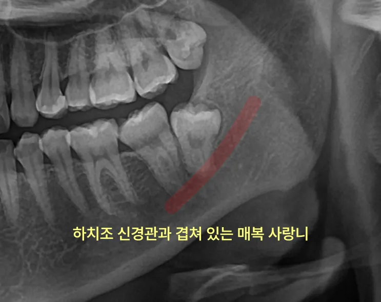 신경과 가까운 사랑니를 방치하면 어떻게 되나요? 4 하치조 신경관에 겹쳐 있는 매복 사랑니 엑스레이 사진
