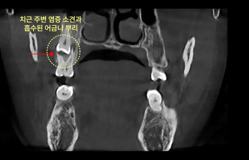 치근 주변 염증과 흡수된 어금니 뿌리를 보여주는 CT 사진